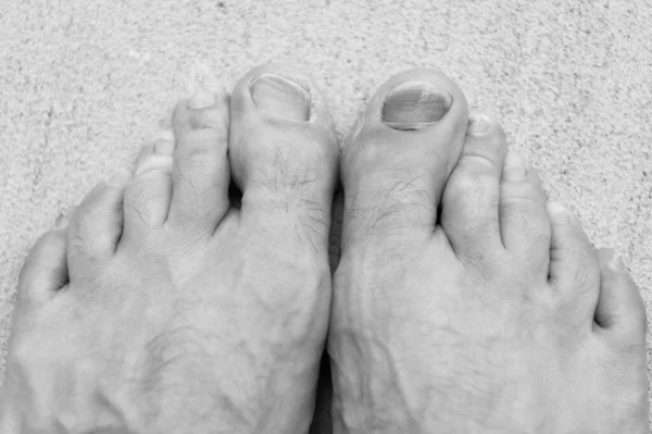Toe Nail Bruise Hemtoma Subungal Toe Nail Bruise Hemtoma Closeup — Stock fotografie