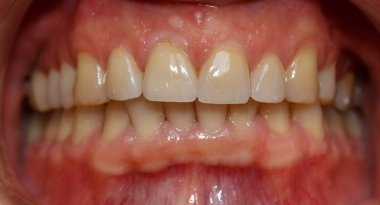 Doğal renklerde seramik kaplamalı insan ön dişi protezleri. Estetik dişçilik. Diş protezi, kaplama ve kaplama. Dişlerin restorasyonu.