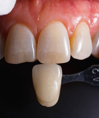 Siyah arkaplandaki numuneyi kullanarak diş renginin belirlenmesi. Protez dişler için hazırlık. Estetik dişçilik. Diş beyazlatma. İnsan gülümsemesi. Diş Sağlığı.