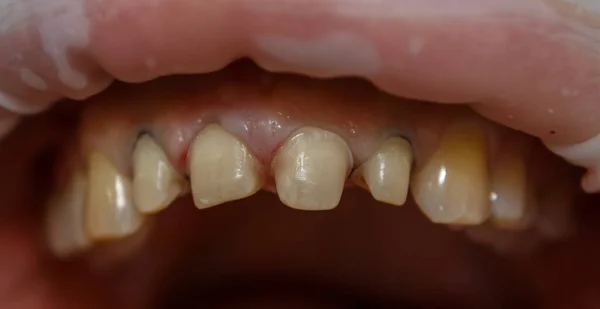 Příprava Protetické Zuby Zuby Léčené Protézy Korunami Zatažení Dásní Pomocí — Stock fotografie