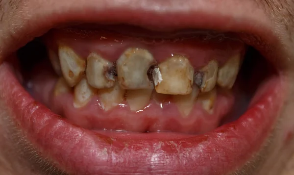 Patient Avec Une Mauvaise Hygiène Dentaire Les Dents Sont Affectées — Photo