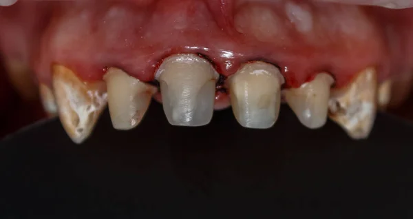 Préparation Aux Prothèses Dentaires Dents Restaurées Aide Matériaux Composites Traitées — Photo