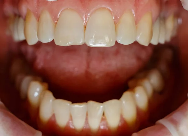 Людські Передні Зуби Протезування Керамічними Вінірами Зуби Перед Лікуванням Подрібнена — стокове фото