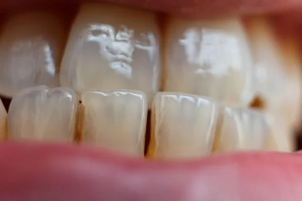 Menschliche Frontzähne Und Lippen Nahaufnahme Natürliche Zahnfarbe Durchscheinender Zahnschmelz Eine Stockfoto