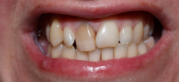Темный передний зуб, выступающий из зубного ряда. Передние зубы человека для протезирования с керамическими винирами. Зубы перед лечением. Эстетическая стоматология. Зубной протез с винирами и коронками. Восстановление зубов.