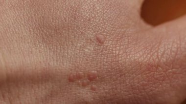 Lazer çıkarmadan önce hastanın elindeki siğili dermatoskop büyüteçle yakından inceleyin. Ellerinde siğil ve papillom muayenesi, tedavi ve tedavi. Bir günlük ameliyat konsepti.