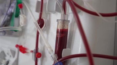 Hemodiyaliz kan hattı tüpleri hemodiyaliz makinesine bağlı. Sağlık, kan temizleme, böbrek yetmezliği, organ nakli. Kan filtreleme sırasında diyaliz ekipmanının bir parçası.