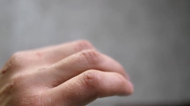 Parmak derisinde siğilleri olan bir elin yakın çekimi. Deri hastalıkları ve papilloma virüsü kavramı. HPV