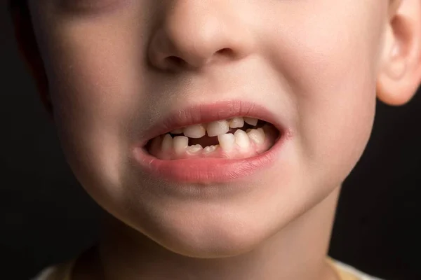 Маленький Мальчик Европейского Внешнего Вида Молоко Коренные Зубы Крупным Планом — стоковое фото