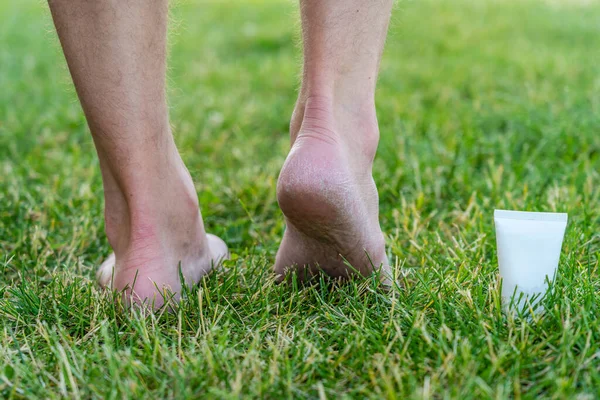 Men's heels (feet) with dry skin and scaly with cream on grass