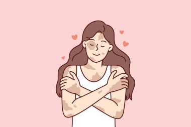 Vitiligo hastalığı olan pozitif bir kız kendine sarılıp cilt hastalıklarını kişisel bir özellik olarak görüyor. Dermatolojik hastalık ya da vitiligo sendromu olan insanlarda vücut pozitifliği kavramları 