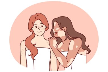 Vitiligo sendromlu bir kadın banyo havlusu giymiş arkadaşına sarılıyor ve arkadaşlık ve hoşgörünün tadını çıkarırken gülüyor. Teninde çilli iki neşeli kız arkadaş ya da vitiligo pigmentasyonu ile ilgili lekeler.