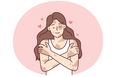 Vitiligo hastalığı olan pozitif bir kız kendine sarılıp cilt hastalıklarını kişisel bir özellik olarak görüyor. Dermatolojik hastalık ya da vitiligo sendromu olan insanlarda vücut pozitifliği kavramları