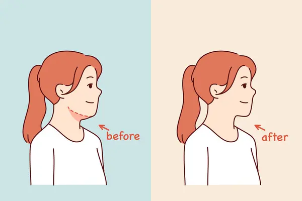 stock vector Double chin removal surgery for young girl posing before and after procedure with cosmetologist. Losing excess weight caused woman to get rid of double chin and increase attractiveness.