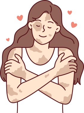 Vitiligo hastalığı olan pozitif bir kız kendine sarılıyor ve cilt hastalıklarını kişisel bir özellik olarak görüyor.