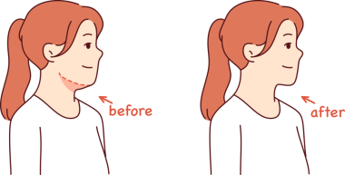 Kozmetikçiyle ameliyattan önce ve sonra poz veren genç kız için çift çene ameliyatı. Fazla kilo vermek kadınların çenelerini kaldırmasına ve çekiciliğini arttırmasına neden oldu..