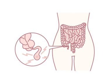 Closeup of human body with inflamed appendix. Person suffer from appendicitis need surgery. Vector illustration.