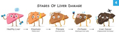 Karaciğer hasarı aşamaları. Karaciğer hastalığının ilerleyişiyle ilgili sevimli tıbbi çizgi film karakterlerinin derlemesi. Vektör .