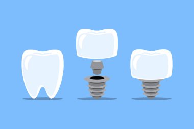 Diş implantı prosedürü kurulumu. Diş ve yapay diş. Düz tasarım karikatür çizimi. Mavi arka planda izole edilmiş. Vektör .