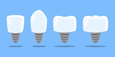 Diş implantı. Diş tipleri; kesici diş, köpek, azı dişi ve azı dişidir. Diş karikatürü çizimi. Mavi arka planda izole edilmiş. Düz dizayn. Vektör .