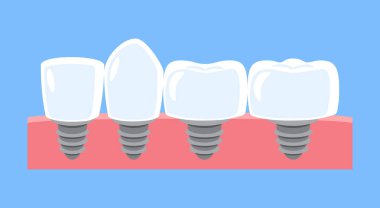 Diş implantı. Diş tipleri; kesici diş, köpek, azı dişi ve azı dişidir. Diş karikatürü çizimi. Mavi arka planda izole edilmiş. Düz dizayn. Vektör .