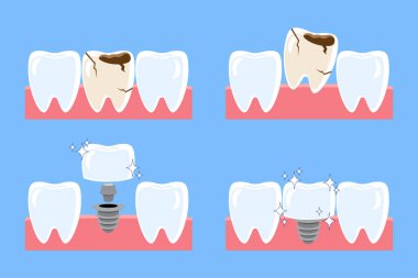 Diş implantı prosedürü kurulumu. Çürük diş çıkarılmış ve yerine yapay diş takılmış. Düz tasarım karikatür çizimi. Mavi arka planda izole edilmiş. Vektör .