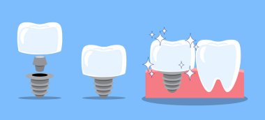 Diş implantı yapısı ve prodeksiyon. Diş karikatürü çizimi. Mavi arka planda izole edilmiş. Vektör .