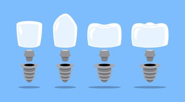 Diş implantı yapısı. Taç, abutment, vida ve fikstür. Diş karikatürü çizimi. Mavi arka planda izole edilmiş. Vektör .
