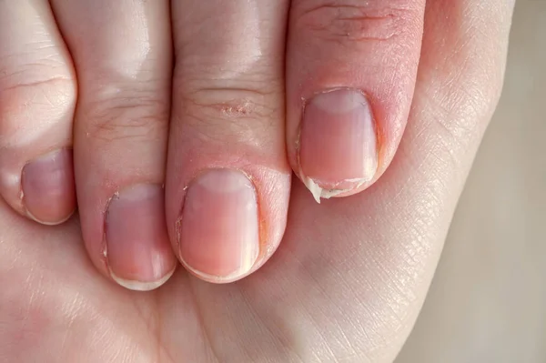 stock image Close-up of brittle nails on womans hands. Female broken fingernail. weak sore nails.