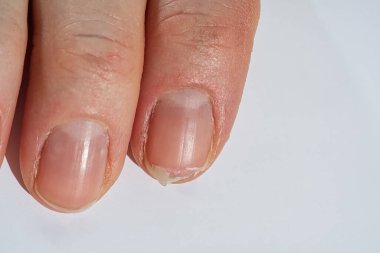 Close-up of brittle nails on womans hands. Female broken fingernail. weak sore nails. clipart