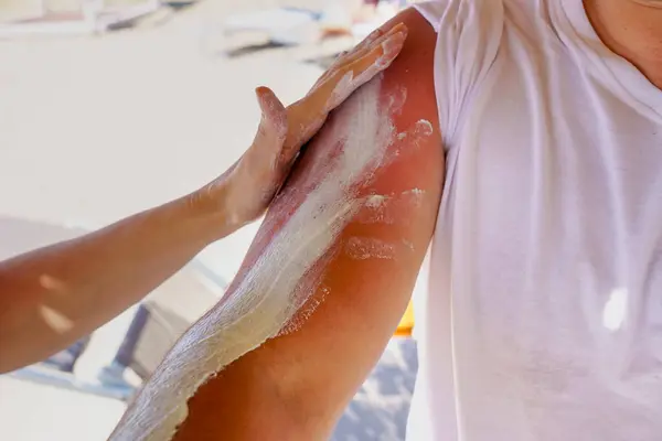 Person applying and spreading sunscreen cream to man back. Sunblock skin prevention. cream to protect the skin from UV sunlight. Solar protection.