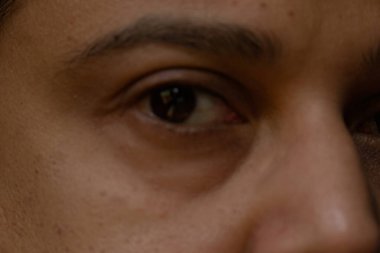 Hint kökenli yetişkin bir erkeğin kısmen görüşü bulanık.