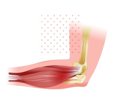 Lateral Epicondylitis known as Tennis Elbow - Stock Illustration as EPS 10 File clipart