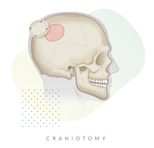 Кранотомічна Хірургія Видалення Кісткового Клапана Стокова Ілюстрація Файл Eps — стоковий вектор