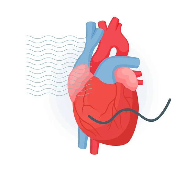 Herzinfarkt Mit Ekg Symbol Als Eps Datei — Stockvektor