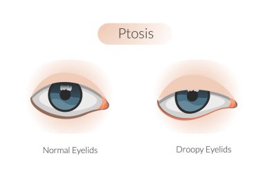 Ptosis drooping upper eyelid - Stock Illustration as EPS 10 File clipart