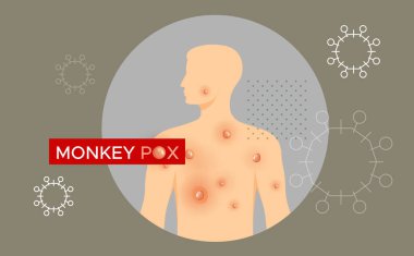 Monkeypox - Skin Rashes and Spots as Symptoms - Icon as EPS 10 File