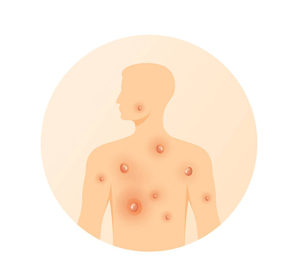 Monkeypox - Skin Rashes and Spots as Symptoms - Icon as EPS 10 File