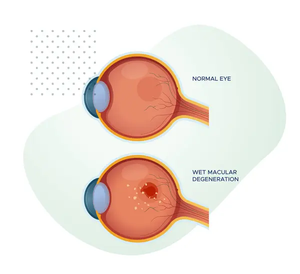 Olhos Saudáveis Degeneração Macular Molhada Ilustração Estoque Como Arquivo Eps — Vetor de Stock