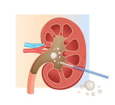 Böbrek Taşı Çıkarma - Perkütan Nephrolithotomy - EPS 10 Dosyası Olarak Stok İllüstrasyonu