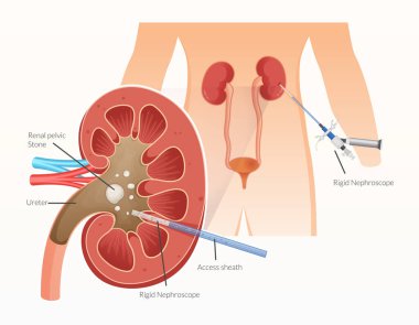Böbrek Taşı Çıkarma - Perkütan Nephrolithotomy - EPS 10 Dosyası Olarak Stok İllüstrasyonu