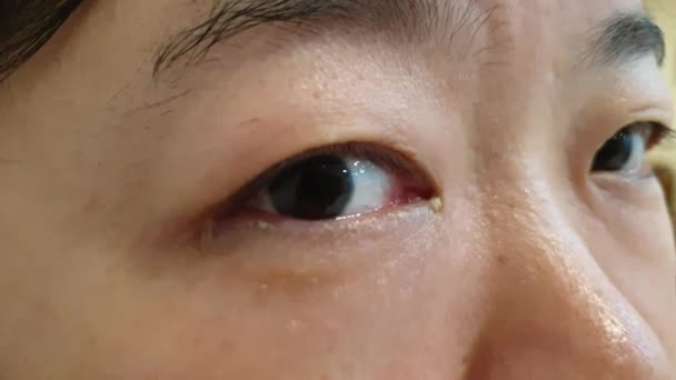 Επιπεφυκίτιδα Κόκκινα Ροζ Μάτια Μολυσμένα Κόμμι Ματιών Amd Βλέννες Όλα — Αρχείο Βίντεο