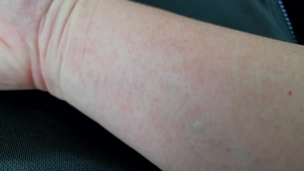 登革热红血疹斑斑症状蚊子热带疾病4K — 图库视频影像