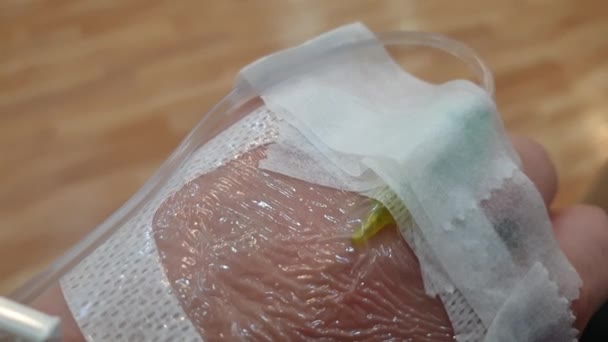 Kochsalzlösung Tubus Und Nadel Vorbereitung Auf Patientenhand Krankenhaus — Stockvideo