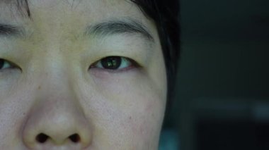Asyalı kadın gözü kaşınıyor. Saplı ve enfekte olmuş kırmızı gözle göz kırpıyor.