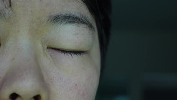 アジアの女性は 染料と赤い目で点滅するかゆみ — ストック動画