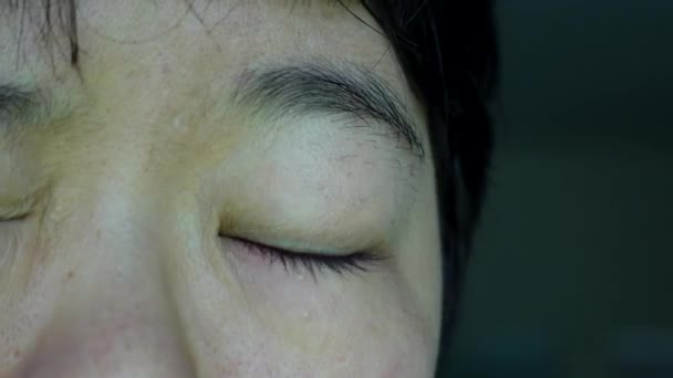 Ázsiai Szem Viszkető Pislogás Pattanás Vörös Szem Fertőzött — Stock videók