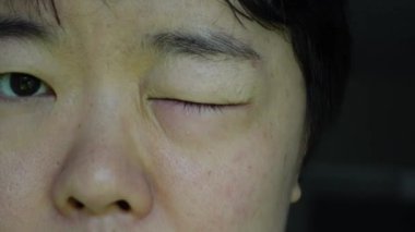 Asyalı kadın gözü kaşınıyor. Kırmızıyla göz kırpıyor ve enfeksiyon kapmış 4K.