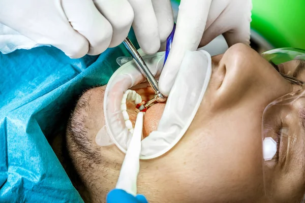 Κοντινό Πλάνο Περιποιητικών Γιατρών Που Κάνουν Χειρουργική Επέμβαση Εγκαθιστώντας Οδοντικά — Φωτογραφία Αρχείου