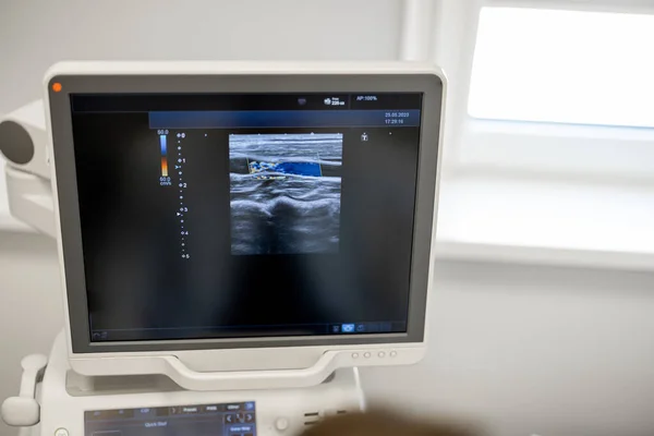 Monitor Tijdens Ultrasoon Onderzoek Van Halsslagader — Stockfoto